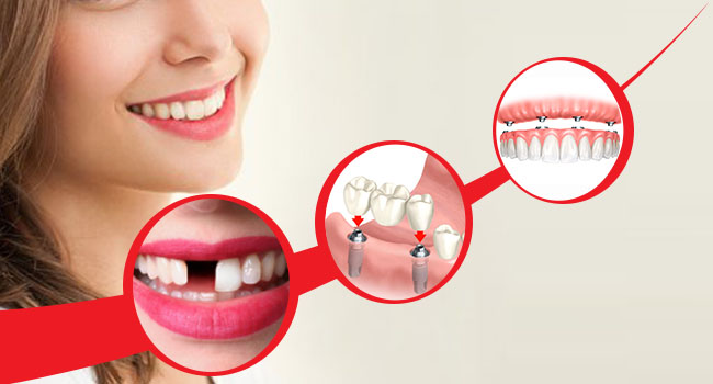 What all are the Replacement for your missing Teeth