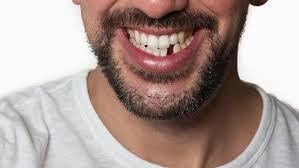 Do I Need to Replace a Missing Tooth