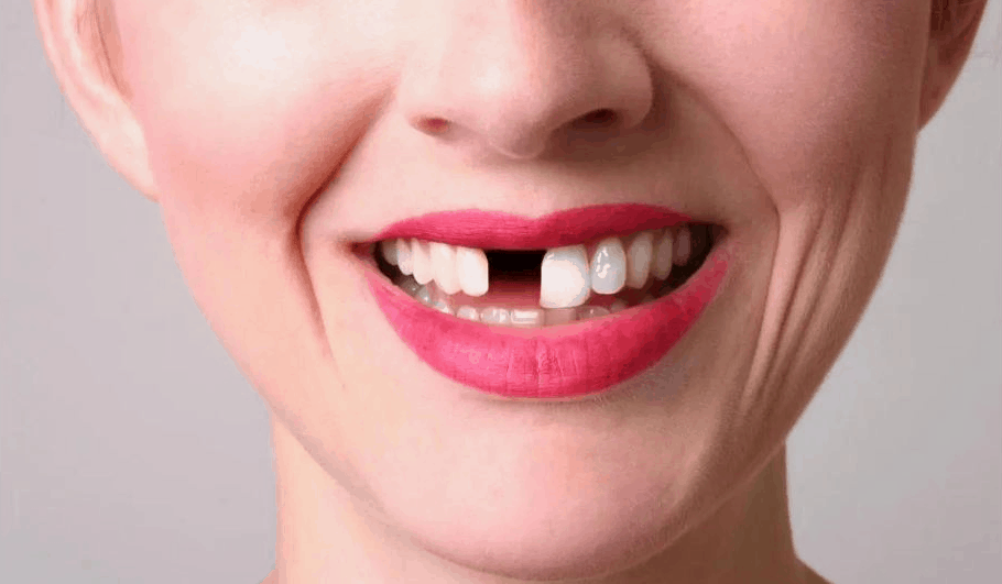 Why Replacing Lost Teeth Is Important