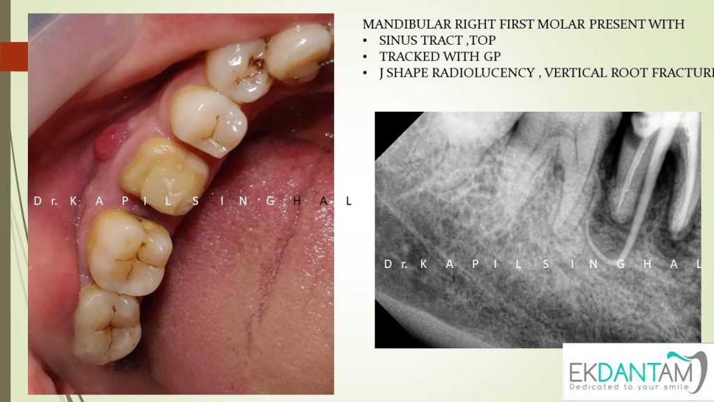 Immediate implant in lower right First Molar