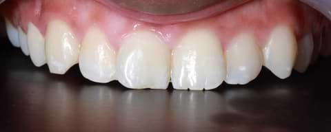 Treatment of white spot lesion!