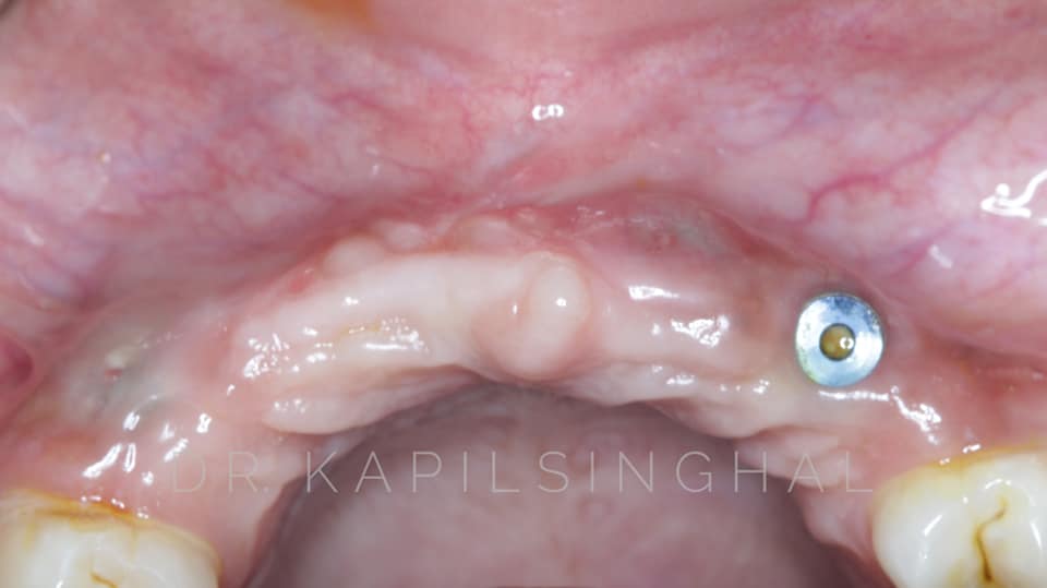 Implant Resurgery With GBR Implants Ekdantam