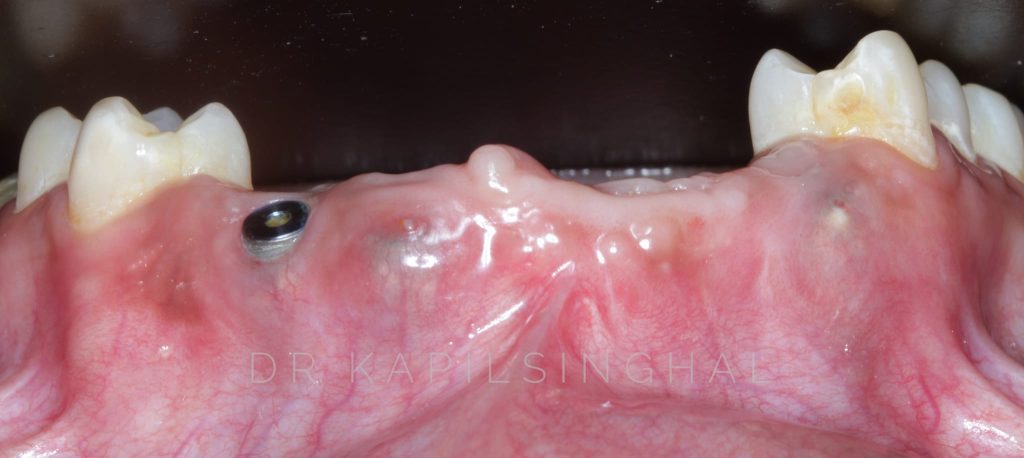 Implant Resurgery With GBR Implants Ekdantam