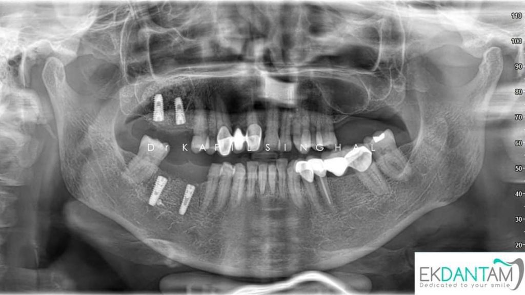 Direct sinus lift and Simultaneous