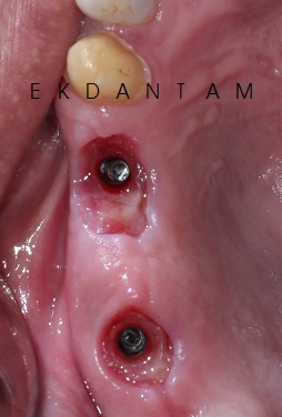 BEST DENTAL IMPLANT DOCTOR IN JAIPUR
