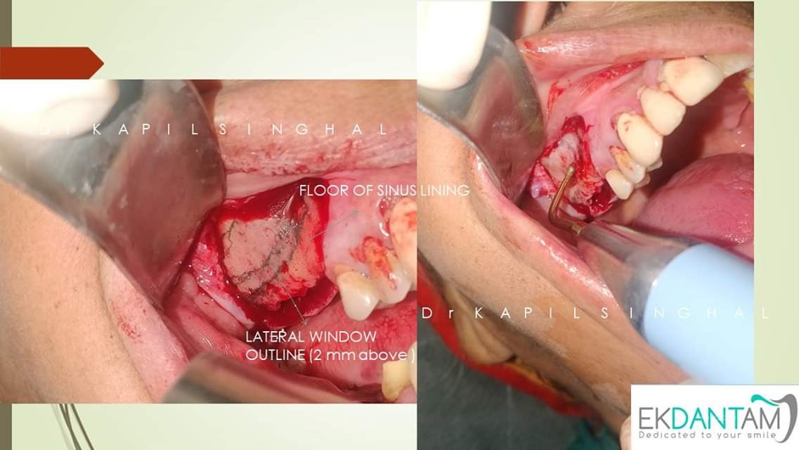 Direct Sinus Lift And Simultaneous - Ekdantam