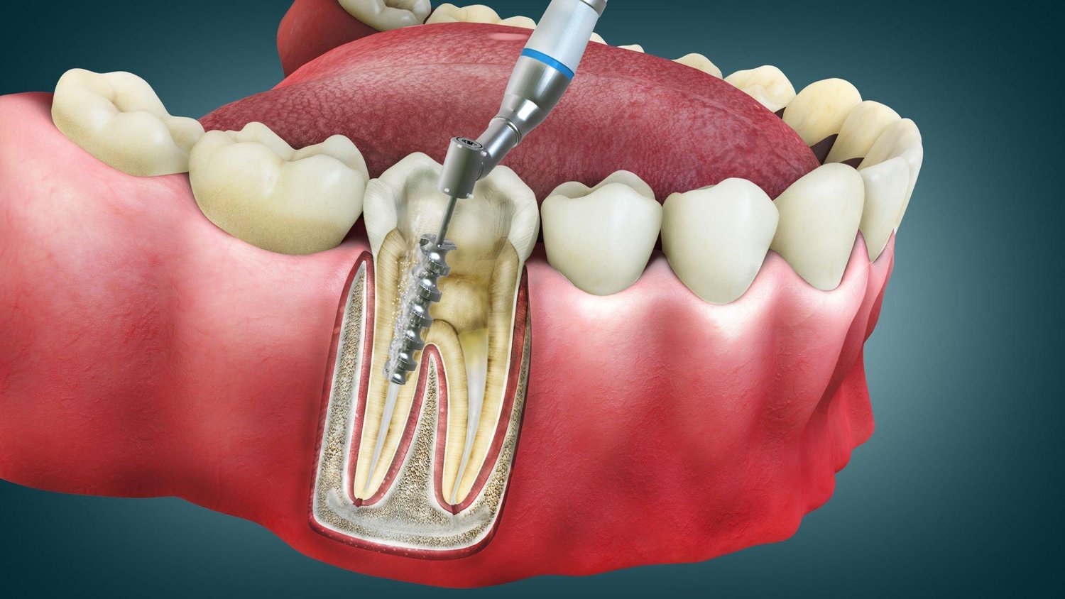 8 Common Myths About Root Canals – Explained Simply