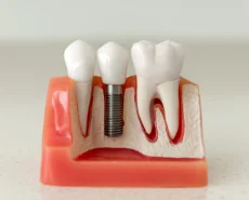 Cross-section model of a jaw showing the structure of a dental implant compared to natural tooth roots.