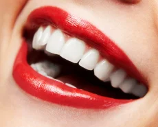 Close-up of a woman's perfect white smile after a smile makeover dental procedure.