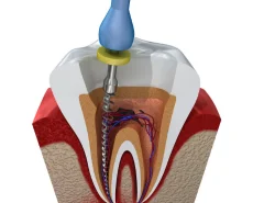 Diagram of a root canal treatment showing the infected pulp being cleaned from a tooth's interior.