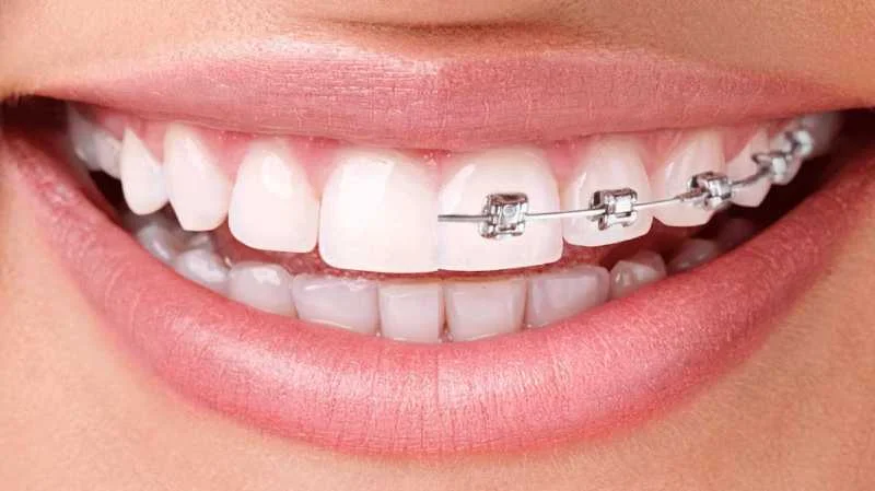 A Comparison Between Invisalign and Metallic Dental Braces