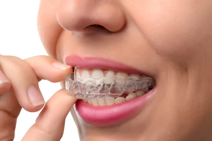 Distinctive Retainer Types Used in Dentistry