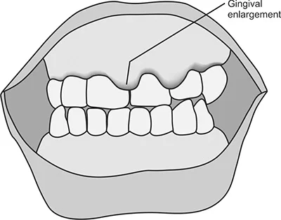 Gingival Enlargements