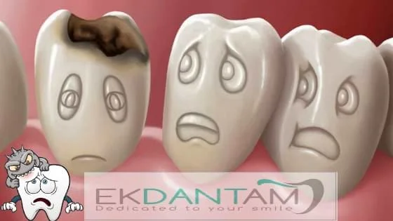 Teeth Cavities Tooth Decay - Causes, Treatment, Pain, prevention