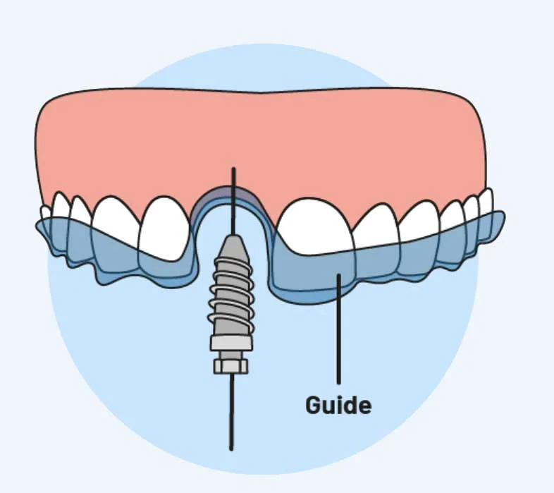 What is 3D guided Dental Implant and Advantages
