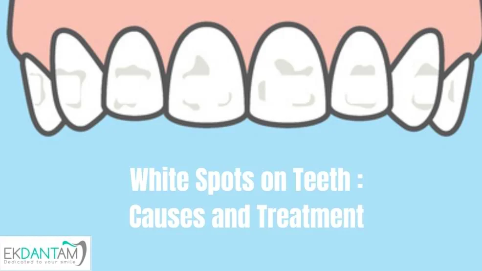 White Spots on Teeth